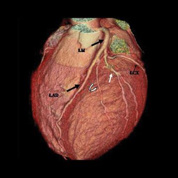 Coronarografia inimii CT